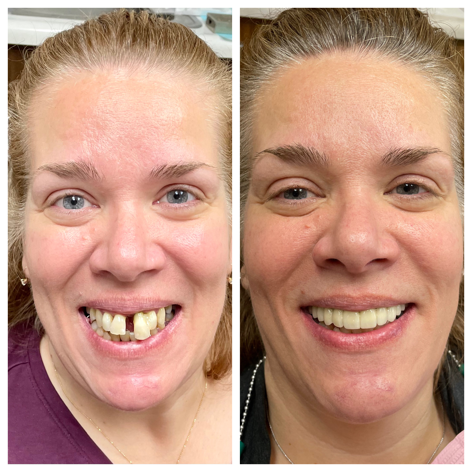 Before and after missing teeth solution result in Fair Lawn NJ