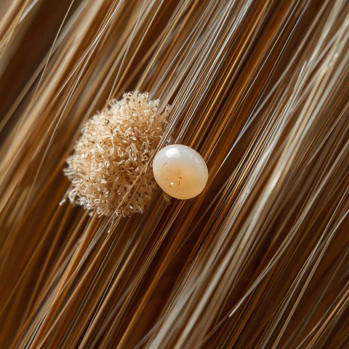 Lice vs dandruff comparison to help parents identify head lice correctly