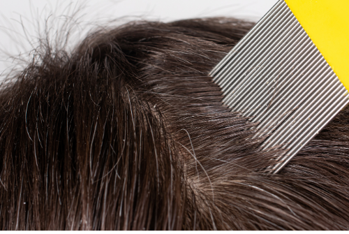 lice treatment atlanta