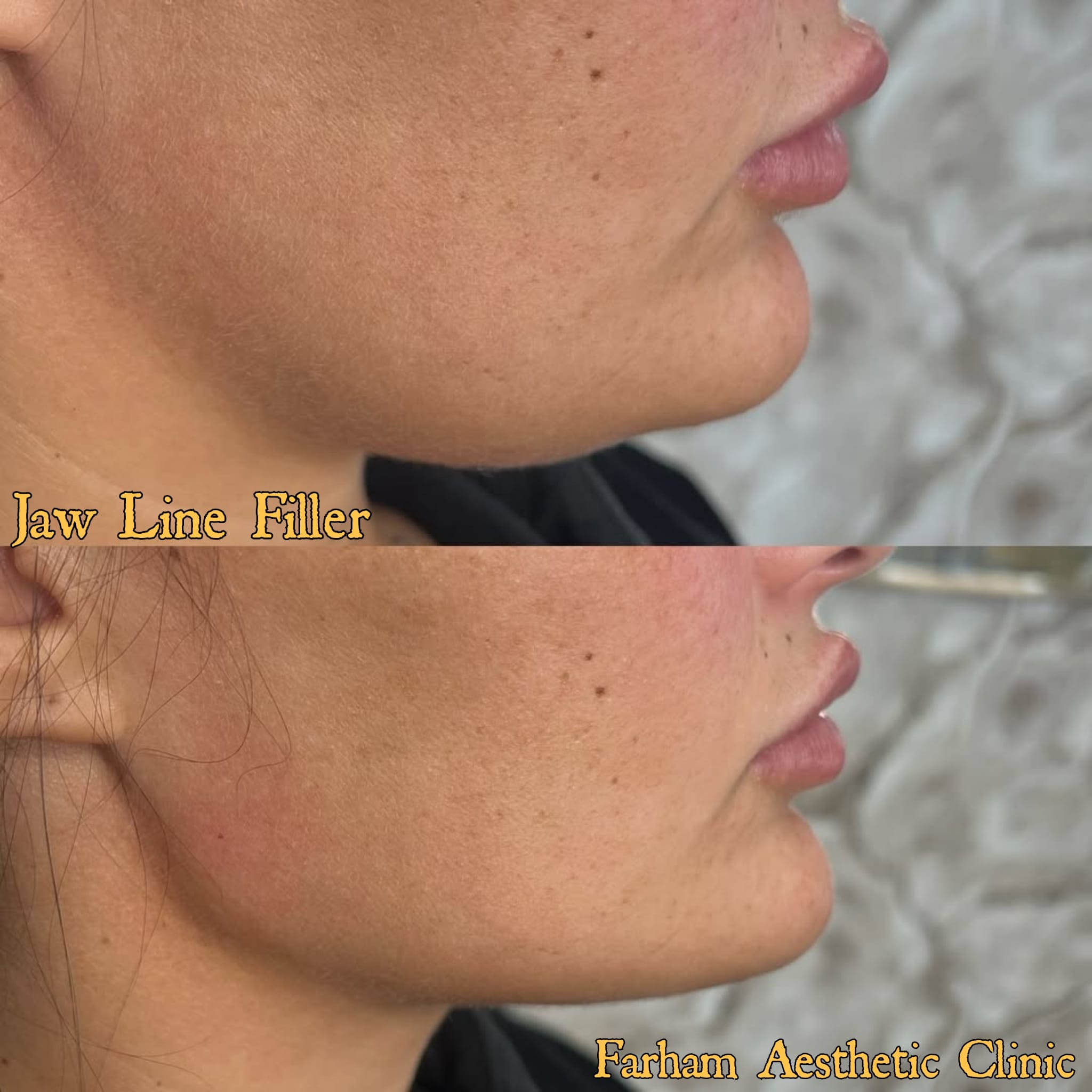 Before and after result, Farham Aesthetic Clinic