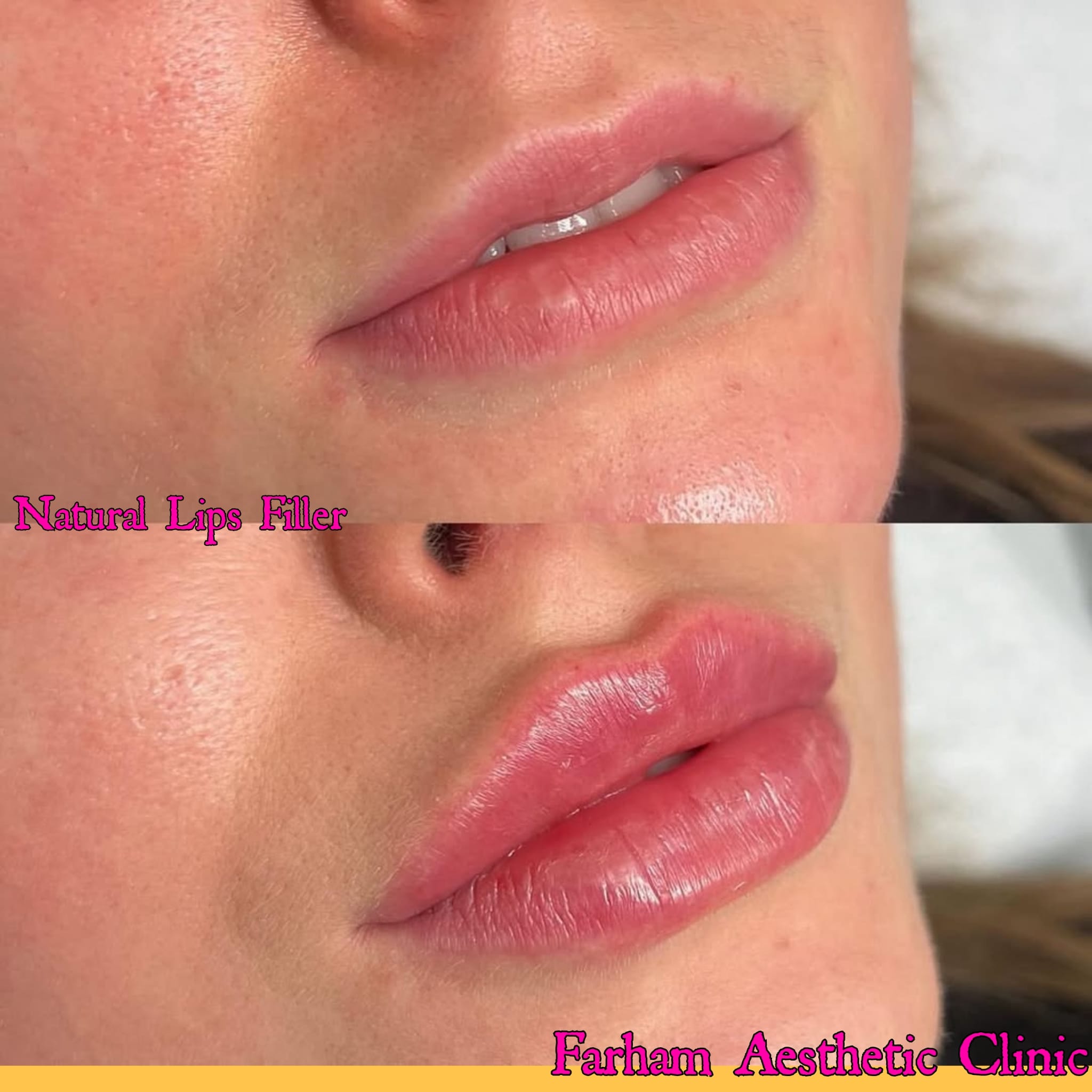 Before and after result, Farham Aesthetic Clinic