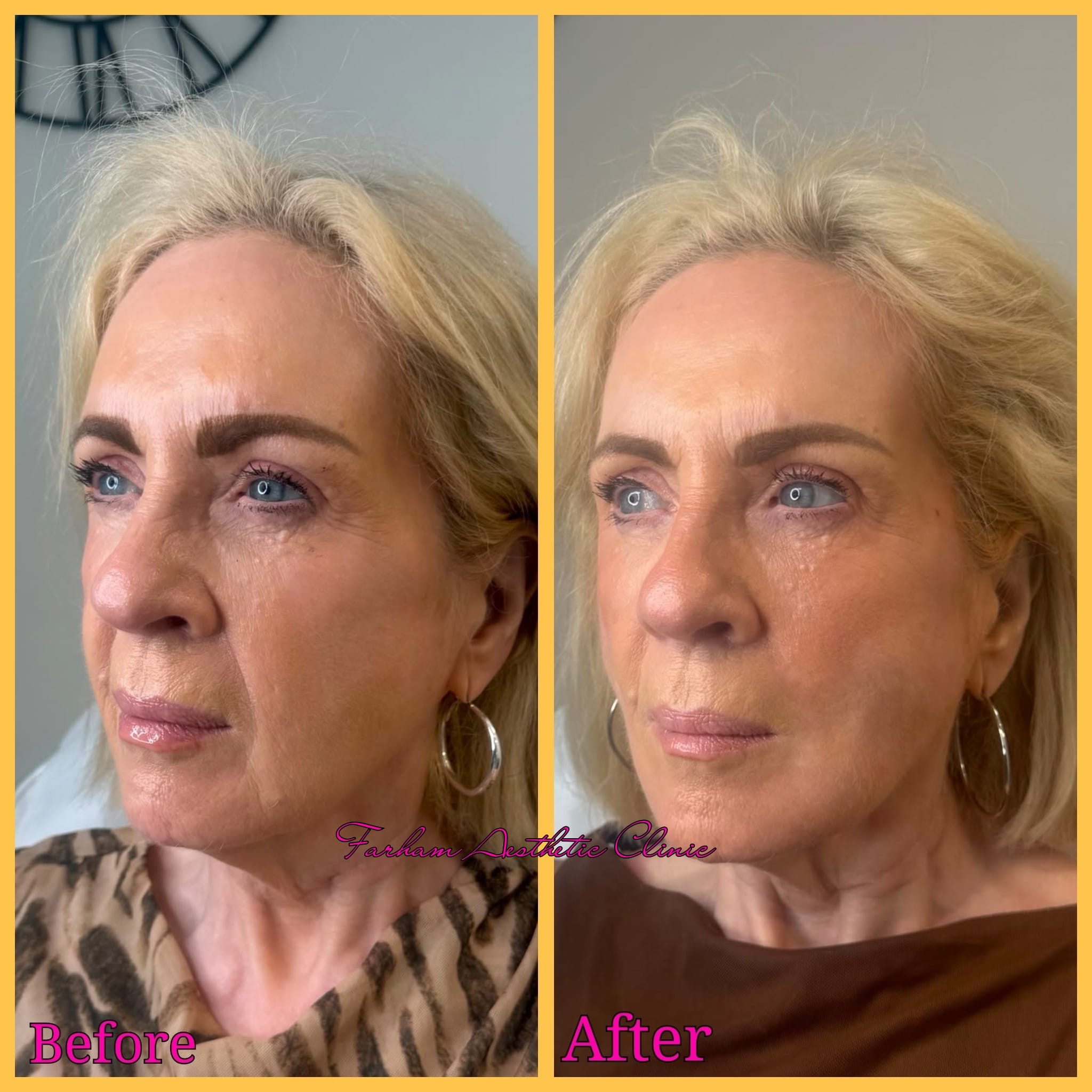 Before and after result, Farham Aesthetic Clinic