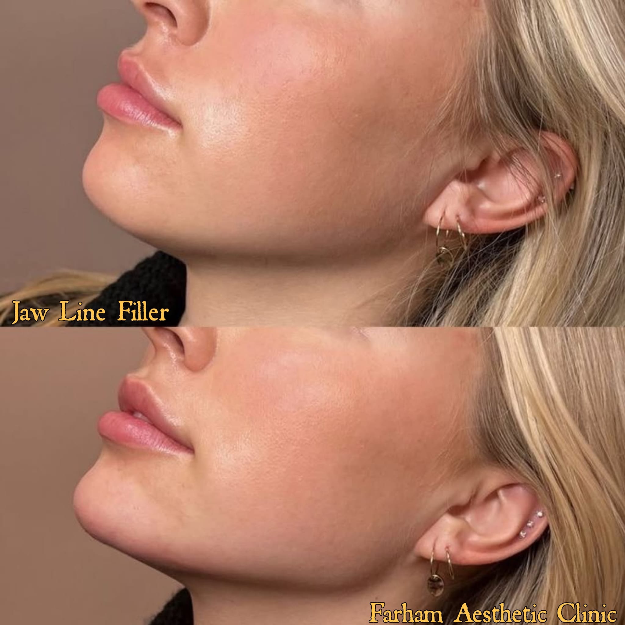 Before and after result, Farham Aesthetic Clinic