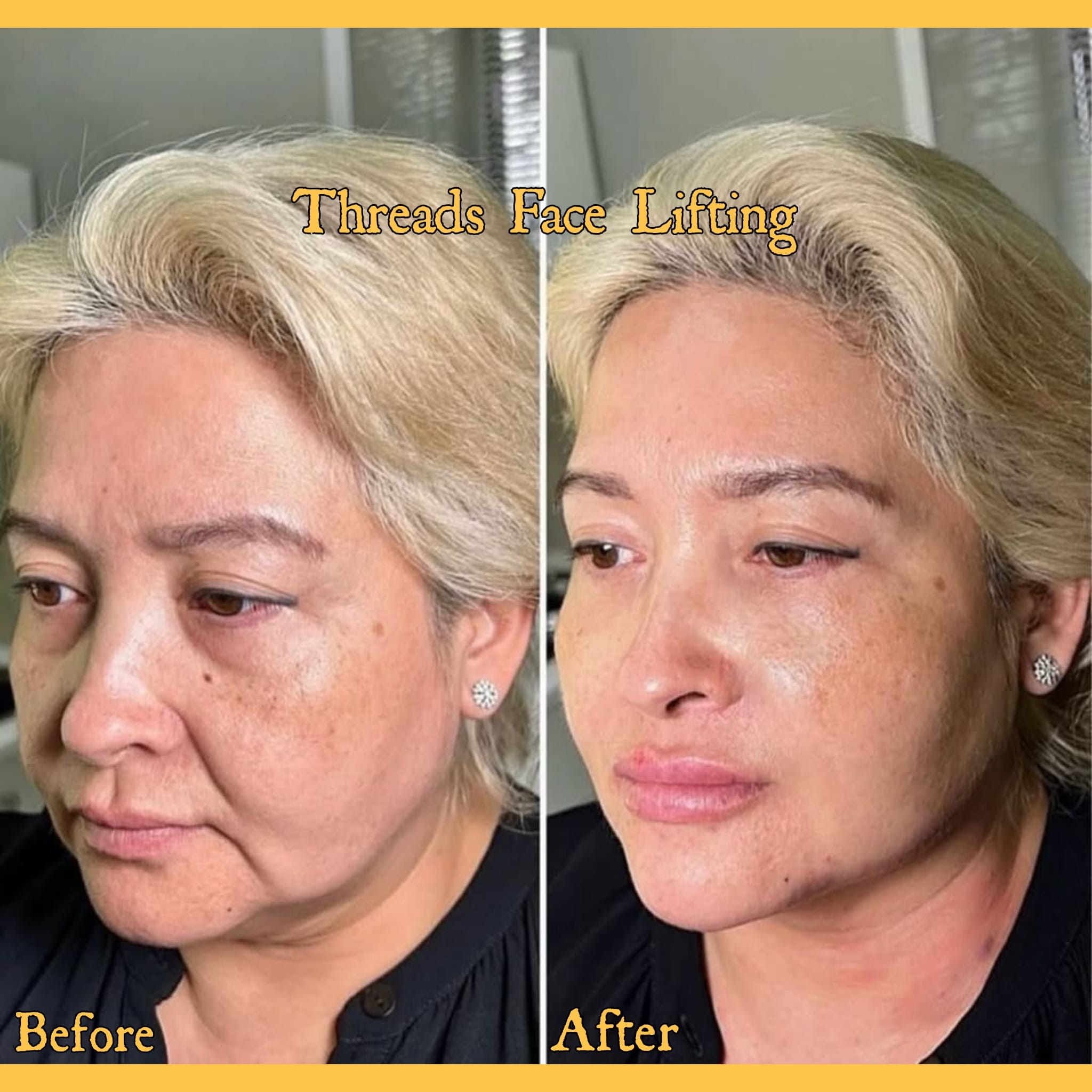 Before and after result, Farham Aesthetic Clinic