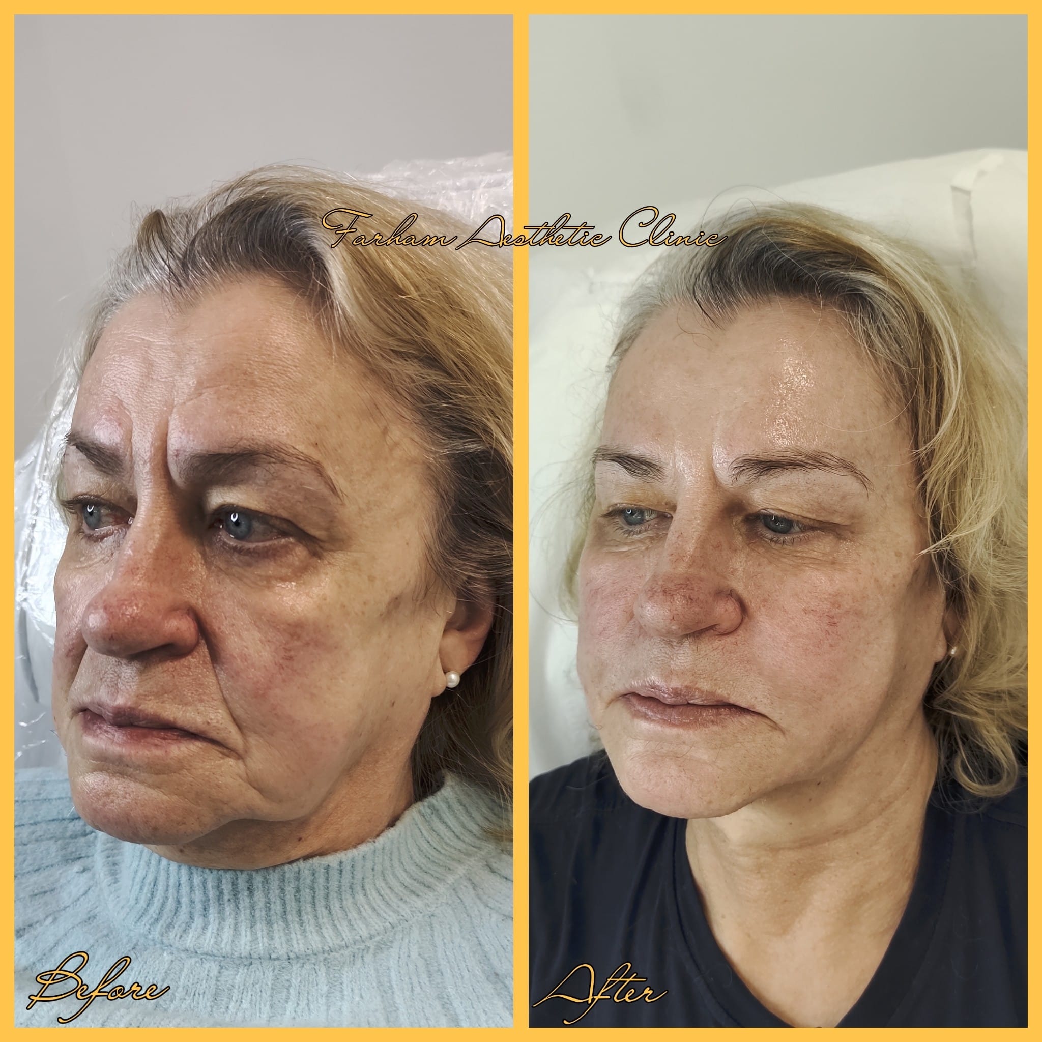 Before and after result, Farham Aesthetic Clinic