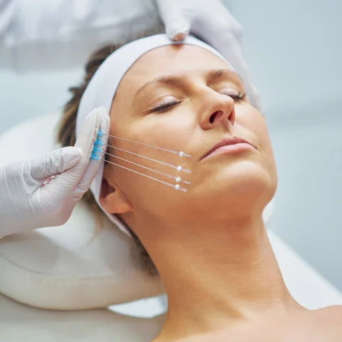 Threads face lift treatment