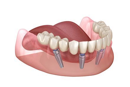 A 3d representation of four implanted screws holding a row of teeth