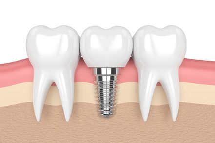 A 3d representation of a tooth shaped crown with a metal screw between two normal teeth