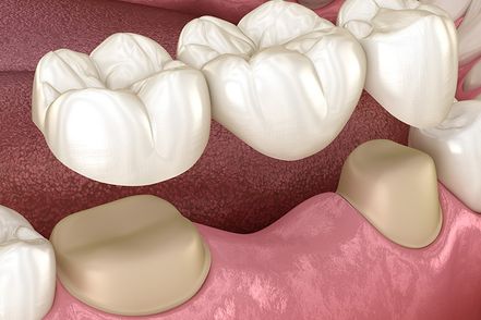 A 3d representation of a bridge of teeth being placed on top of broken and missing teeth