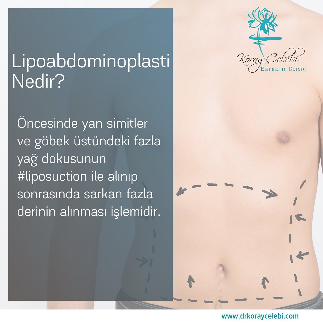 Karın Germe (Abdominoplasti) Öncesi ve Sonrası