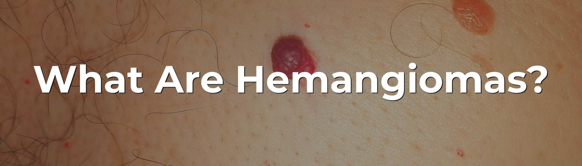 What Are Hemangiomas?