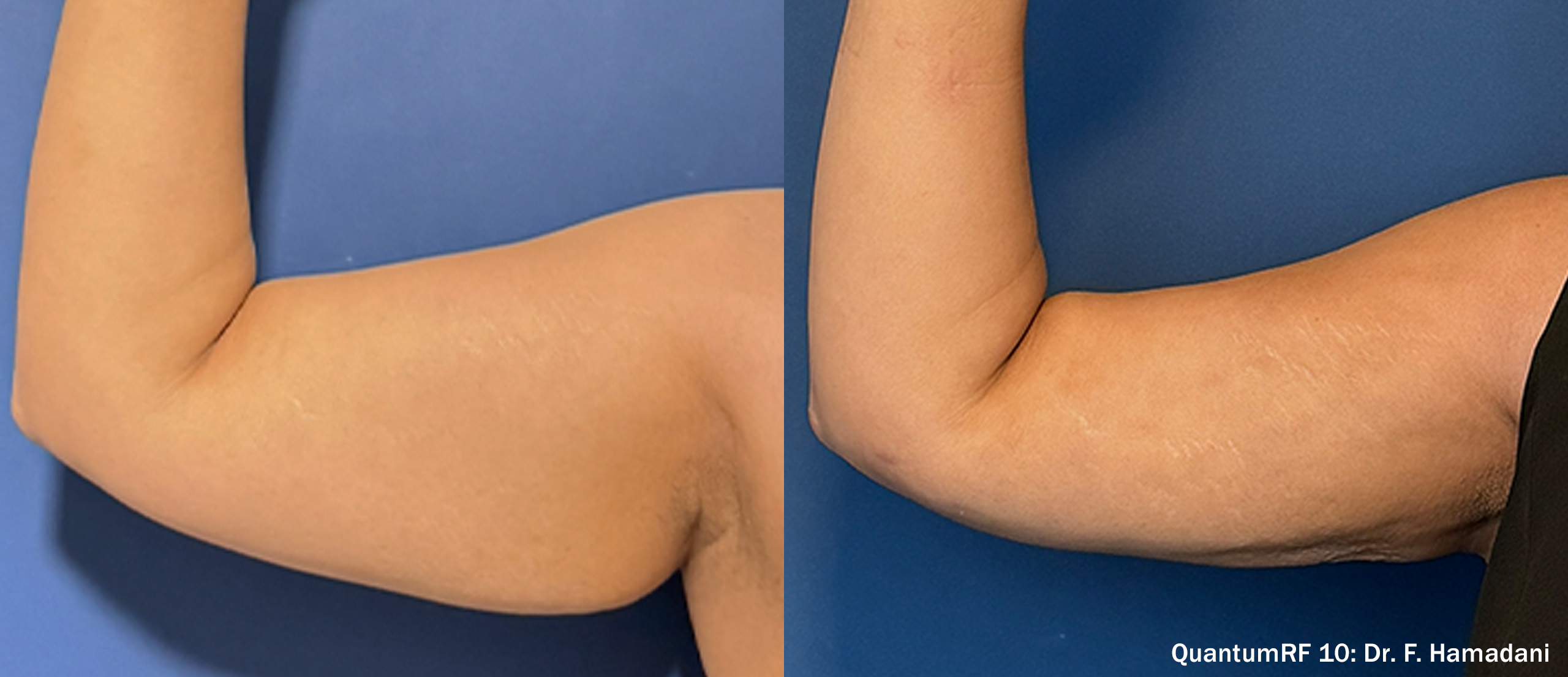 Before and after — patient 6