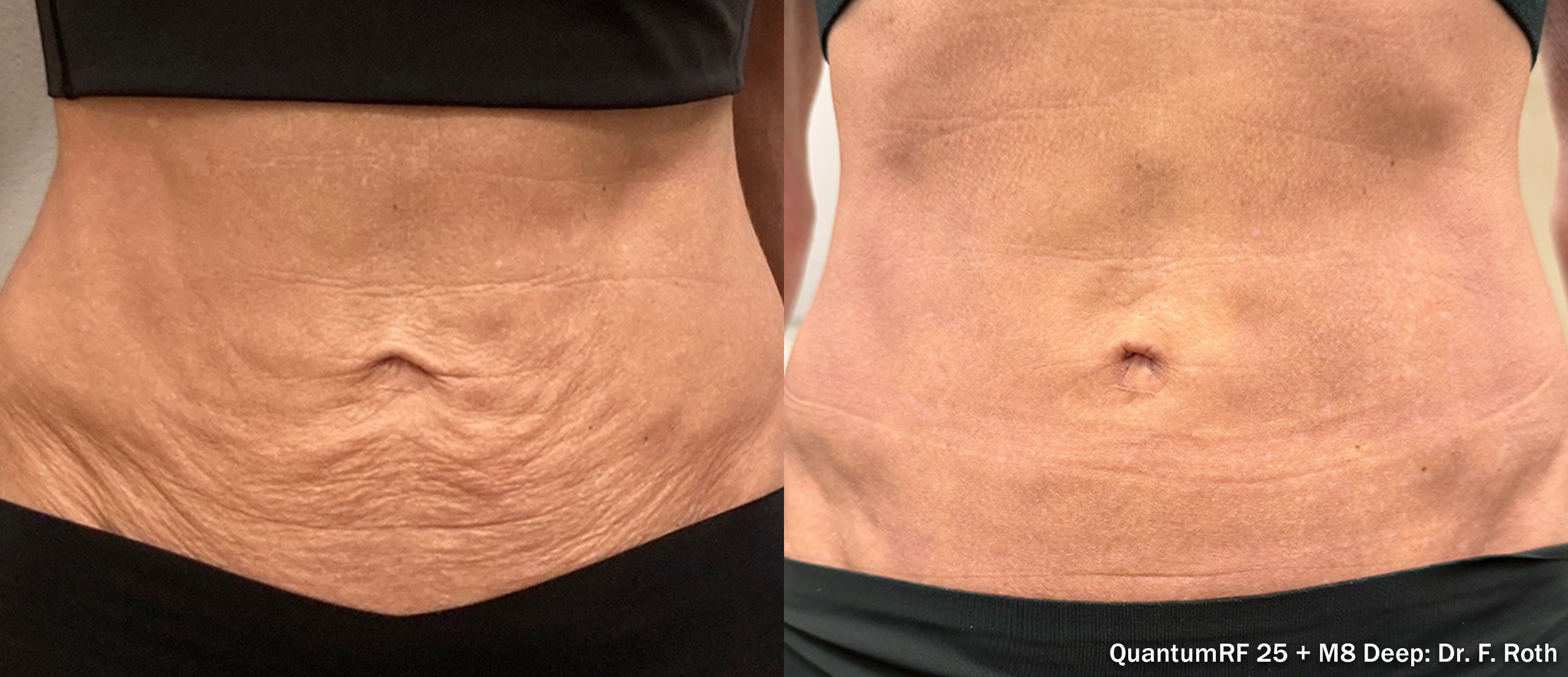 Before and after — patient 5