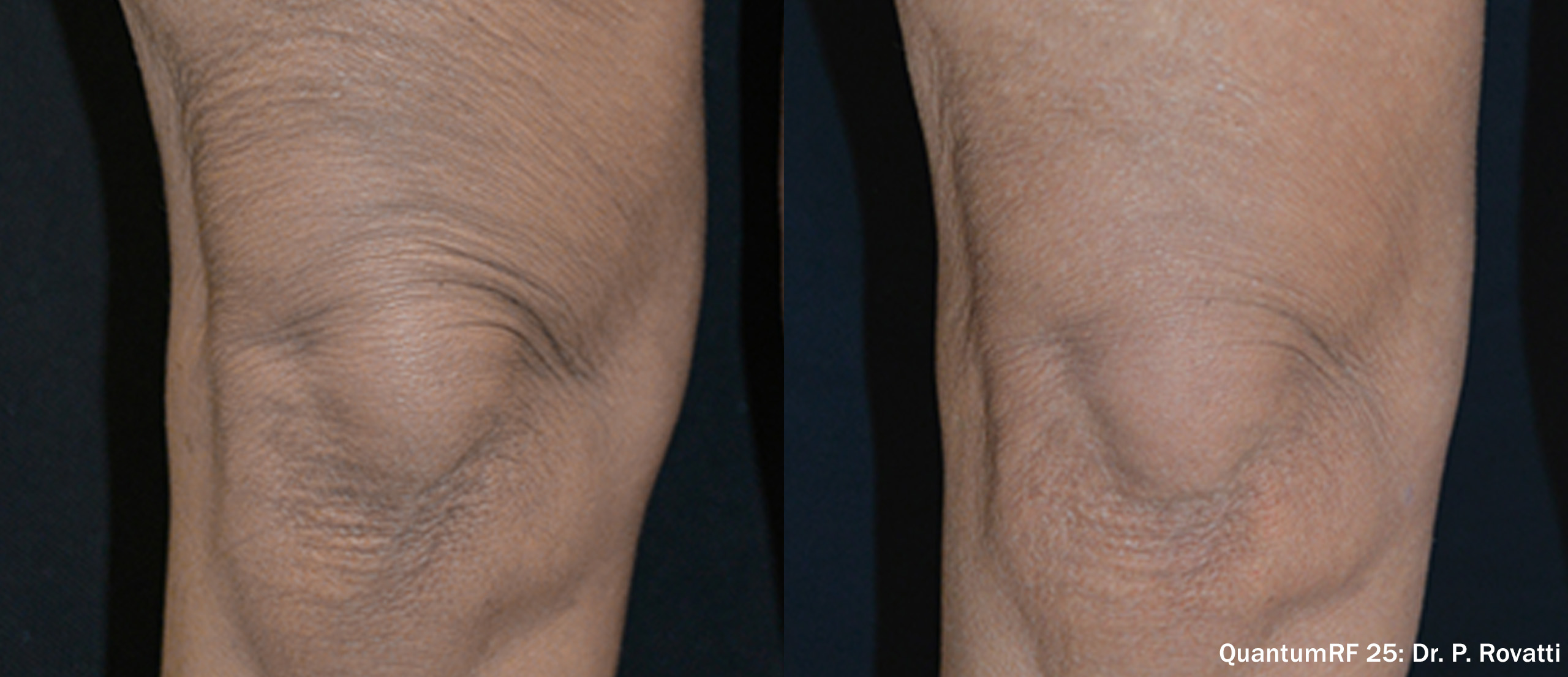 Before and after — patient 4