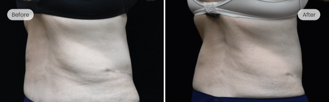 Before and after — patient 3