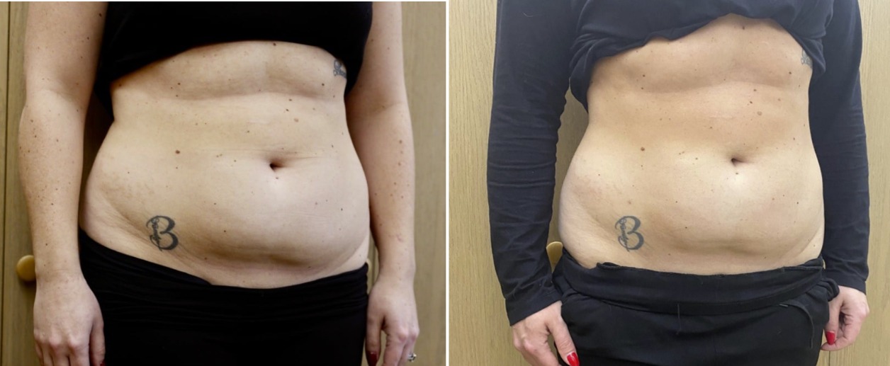 Awake liposuction results at New Viva MD