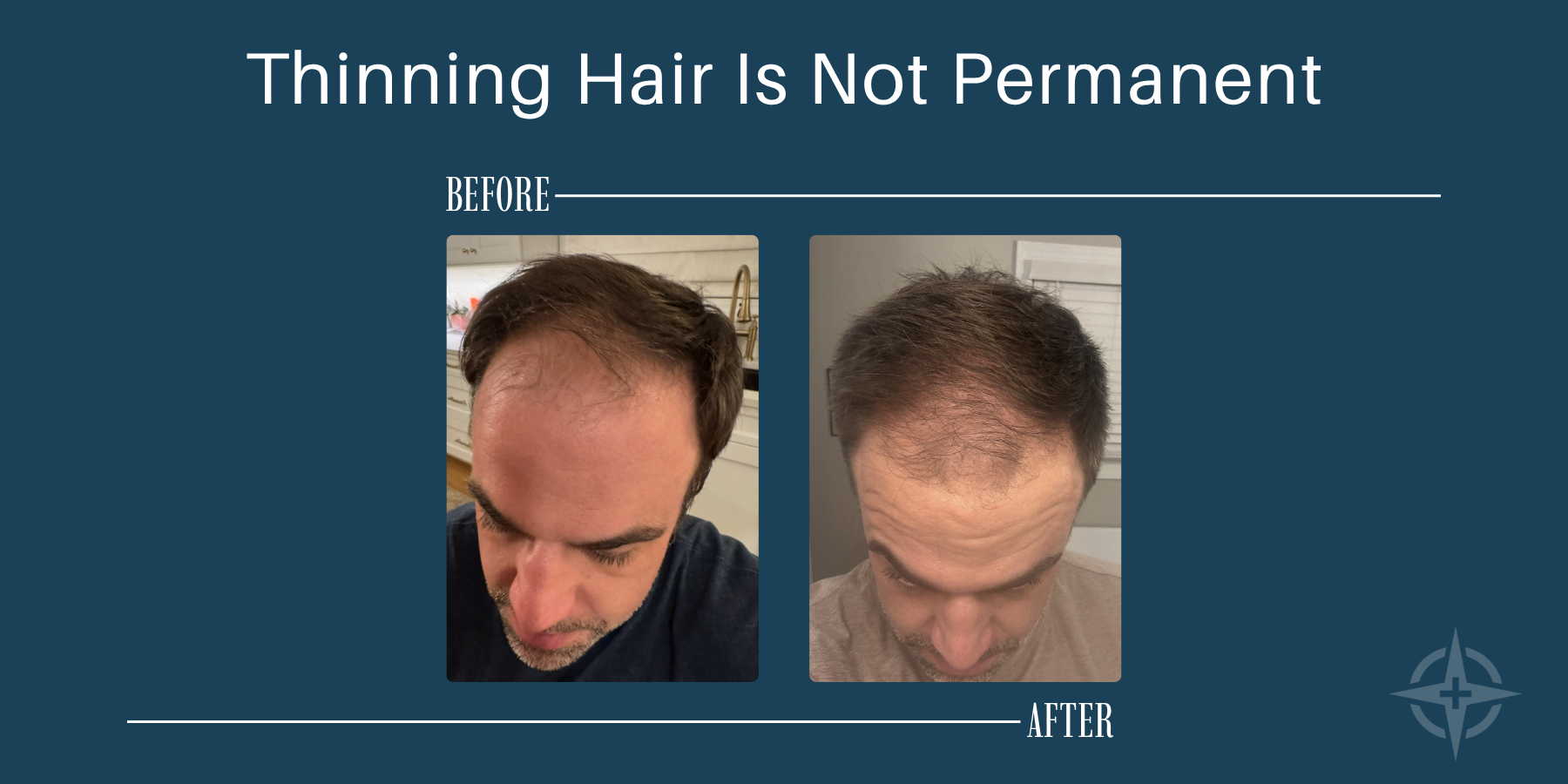 Before and after photos of Logan Taylor, CRNA at Healthcare Evolution, showing hair restoration results on his own scalp.