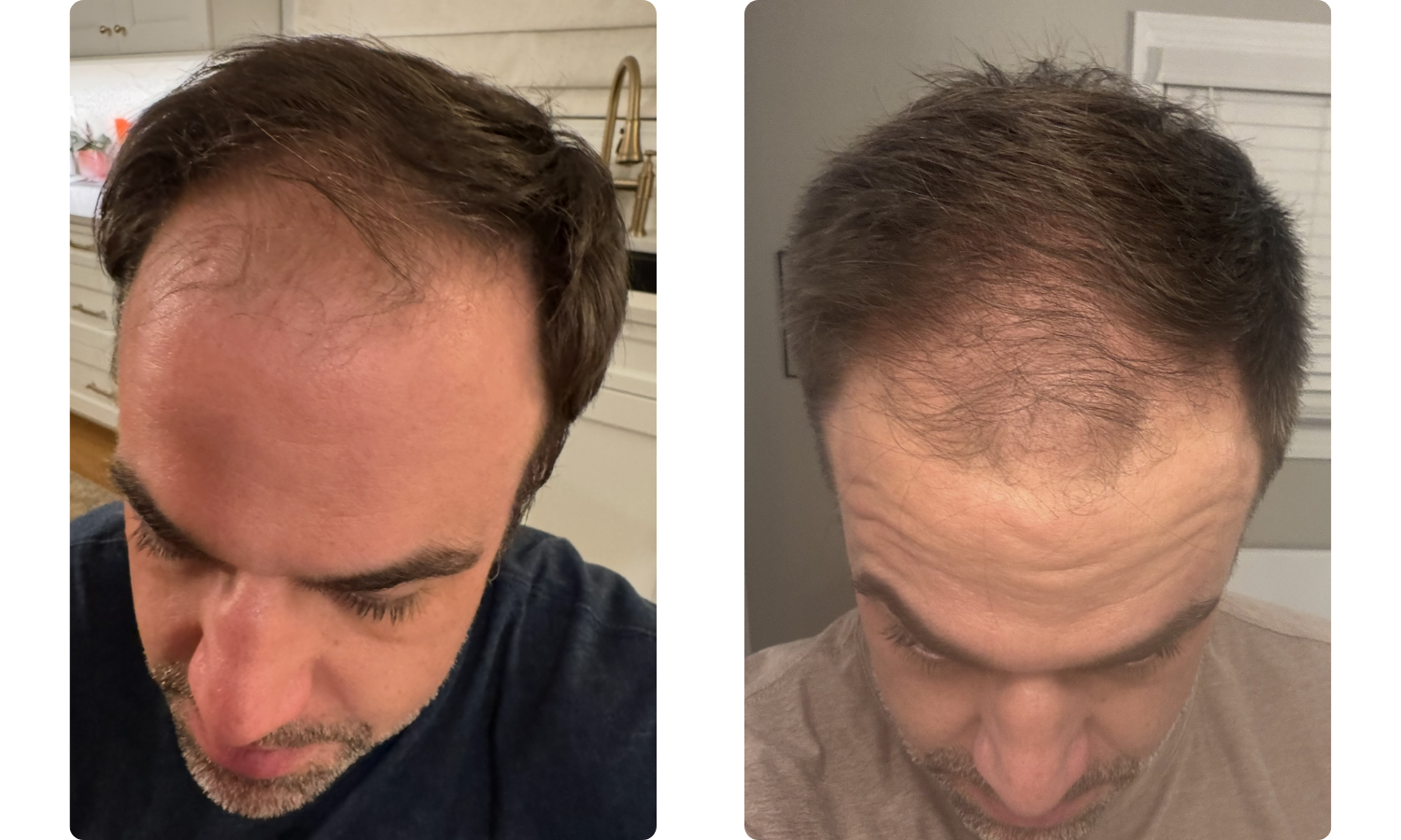 Side by side before and after of Logan Taylor showing thicker hair after regenerative hair restoration.