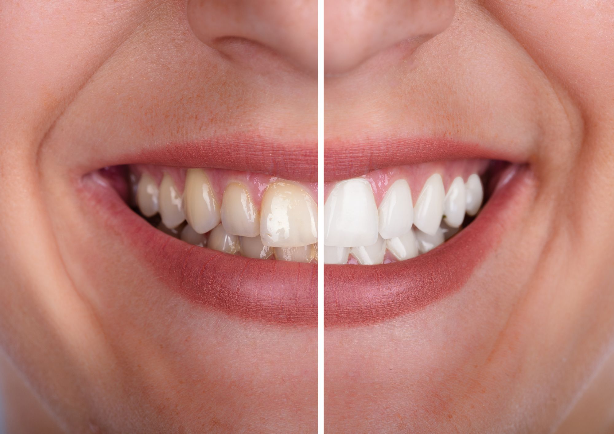 Teeth Whitening at Bombshell Beauty Lash Bar