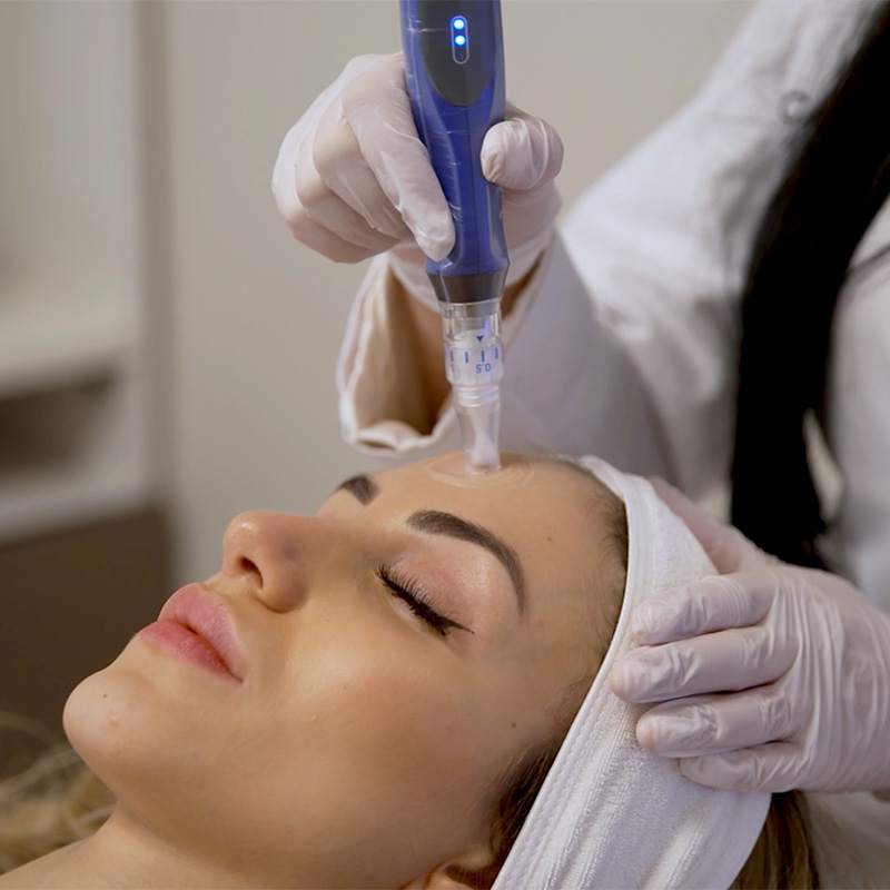 Microneedling in Tyler, TX