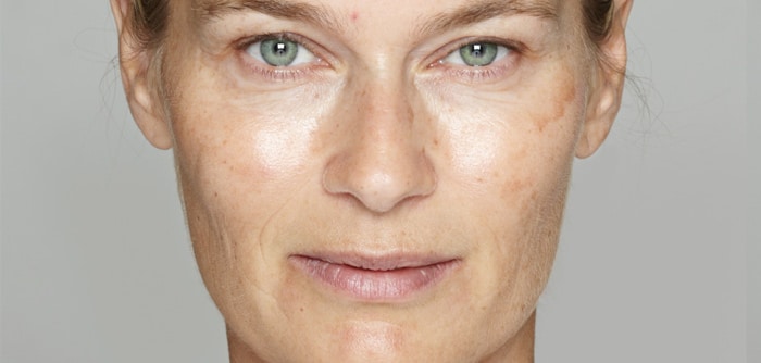 Before treatment at Lola's Med Spa in Tyler, TX