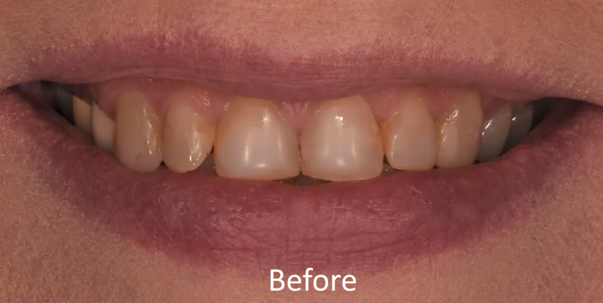 Knoxville Smiles before and after — case 3