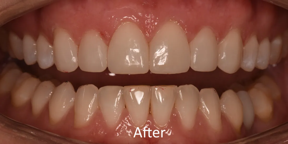 Knoxville Smiles before and after — case 2