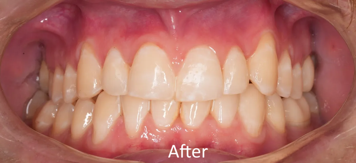 Knoxville Smiles before and after — case 6