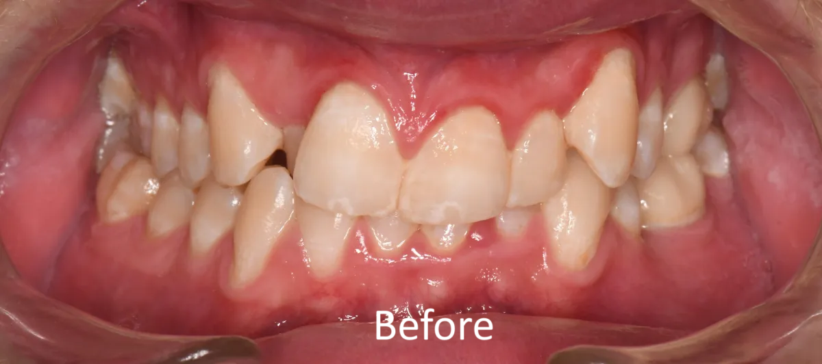 Knoxville Smiles before and after — case 5