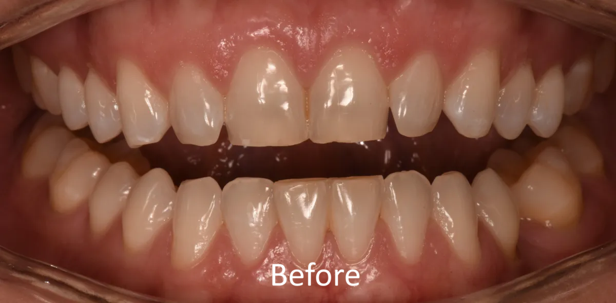 Knoxville Smiles before and after — case 1
