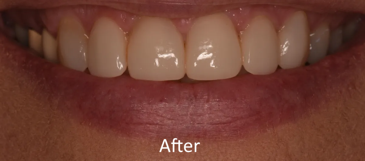 Knoxville Smiles before and after — case 4