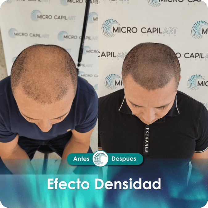 Micropigmentación capilar - Efecto Densidad