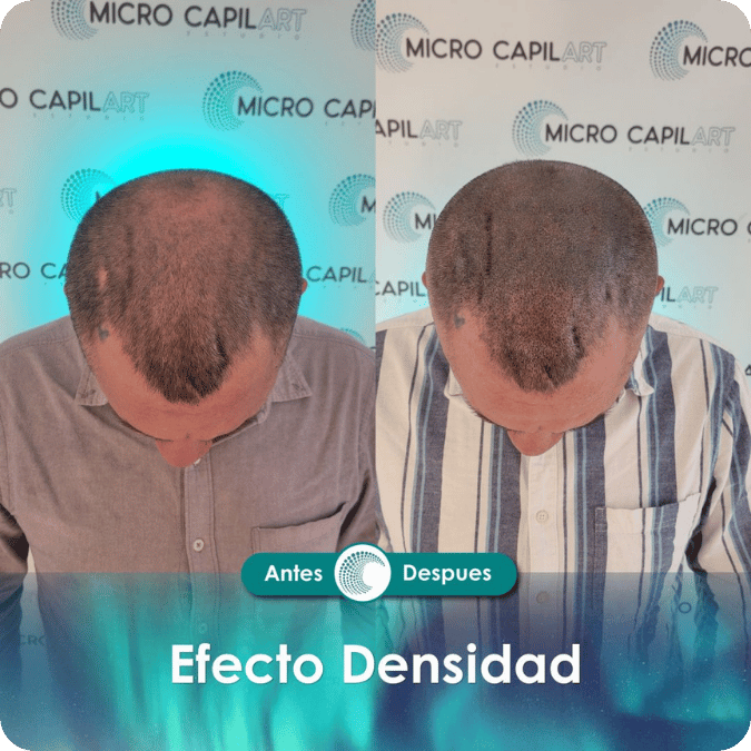 Micropigmentación capilar - Efecto Densidad