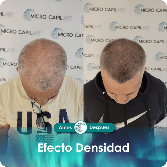Micropigmentación capilar - Efecto Densidad