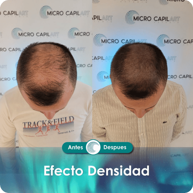 Micropigmentación capilar - Efecto Densidad