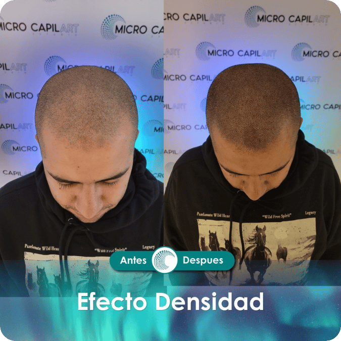 Micropigmentación capilar - Efecto Densidad
