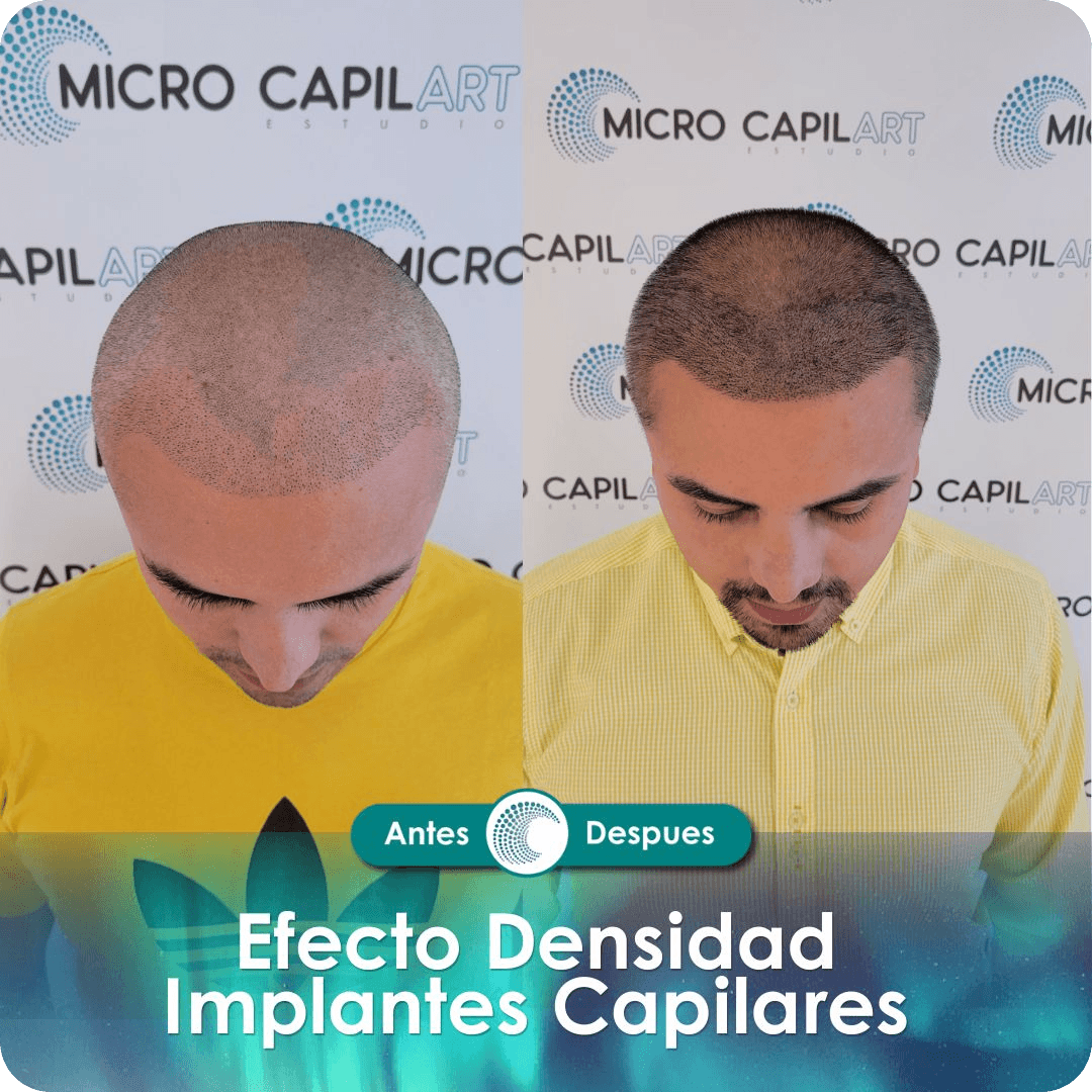 Micropigmentación capilar - Efecto Densidad