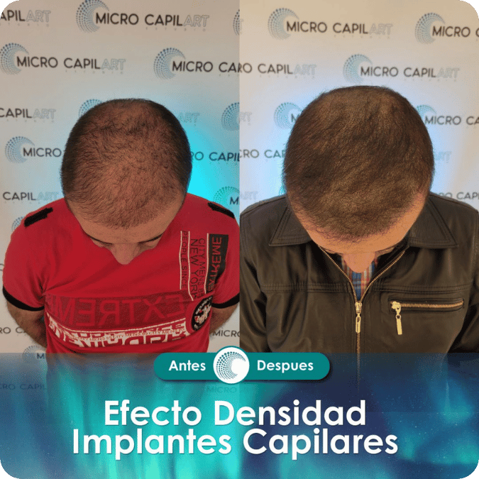 Micropigmentación capilar - Efecto Densidad