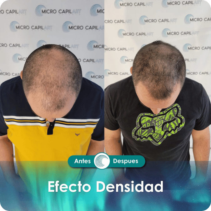 Micropigmentación capilar - Efecto Densidad