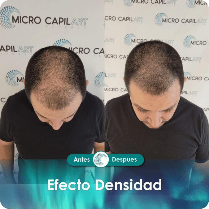 Micropigmentación capilar - Efecto Densidad