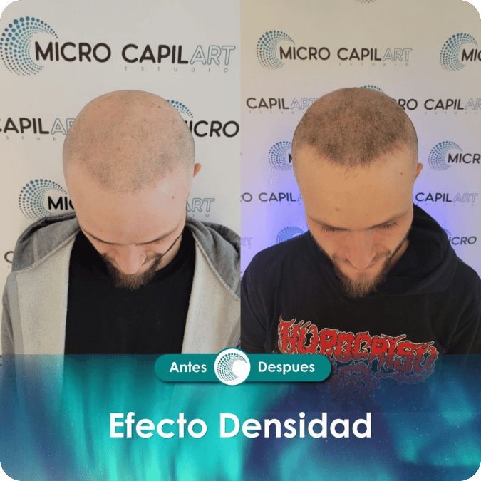Micropigmentación capilar - Efecto Densidad