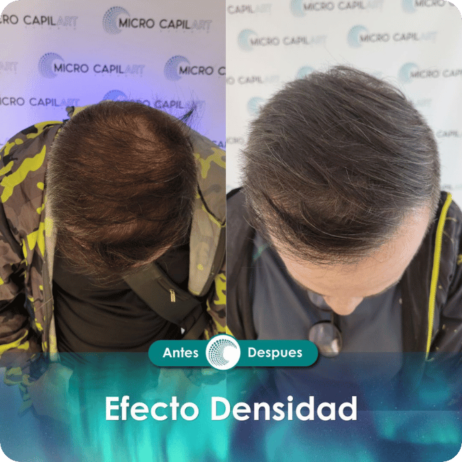 Micropigmentación capilar - Efecto Densidad