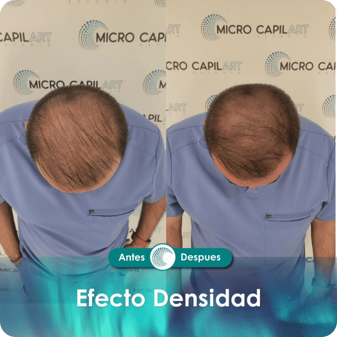 Micropigmentación capilar - Efecto Densidad