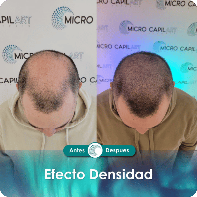 Micropigmentación capilar - Efecto Densidad