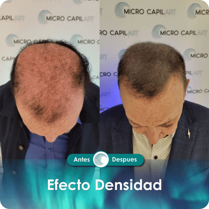Micropigmentación capilar - Efecto Densidad