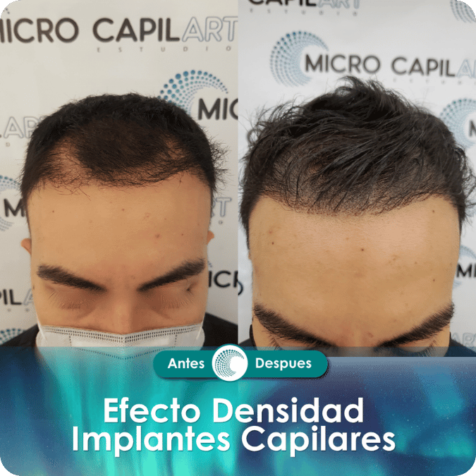 Micropigmentación capilar - Efecto Densidad
