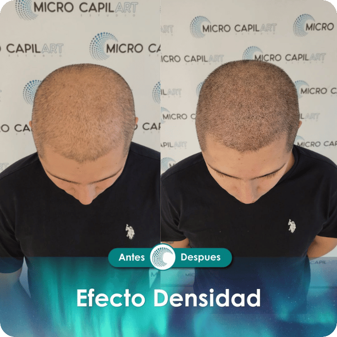 Micropigmentación capilar - Efecto Densidad