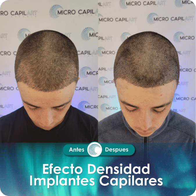 Micropigmentación capilar - Efecto Densidad