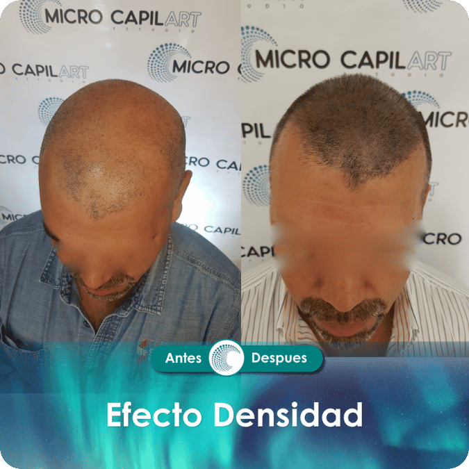Micropigmentación capilar - Efecto Densidad