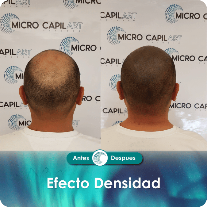 Micropigmentación capilar - Efecto Densidad